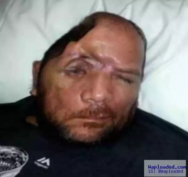 Man Loses Almost Half of His Skull After Police Mistook His Water Bottle for Gun and Shot at Him (Photo)